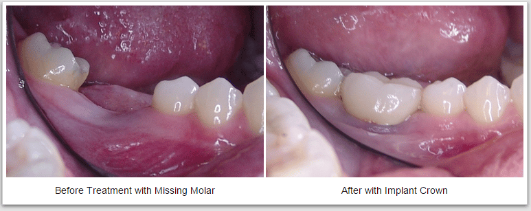 missing molar dental crown implant