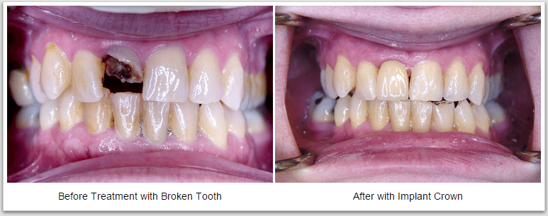 crowns dental implants