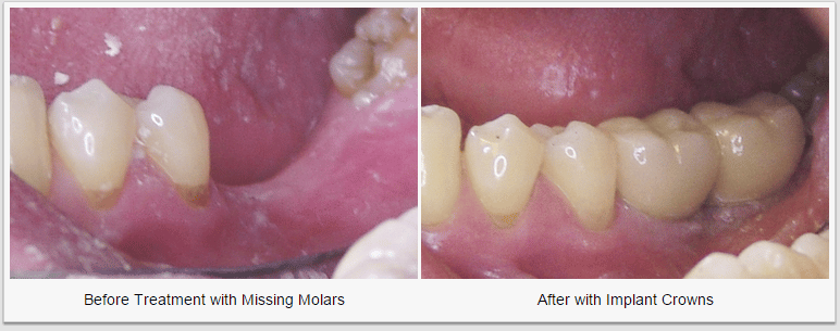 Dental Crown Molar